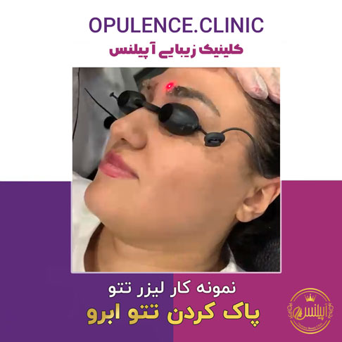 لیزر-کیو-سویچ لیزر کیوسویچ ابرو کرج