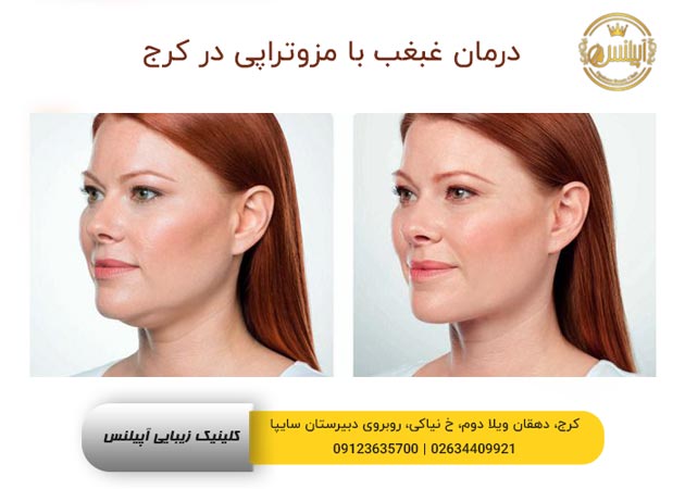 مزوتراپی درمان غبغب در کرج