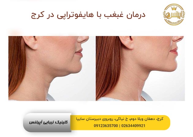 غبغب و هایفوتراپی 