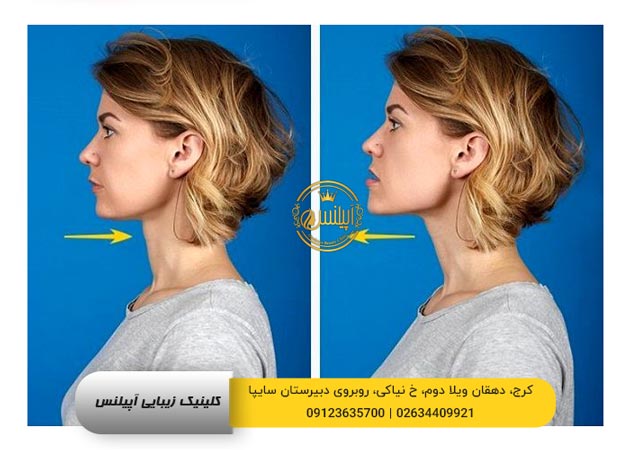 ورزش رفع غبغب در منزل 