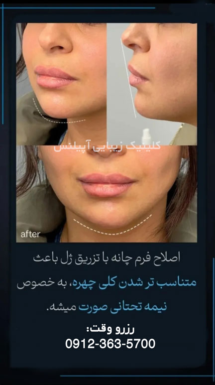 فیلر چانه اصلاح فرم در کرج