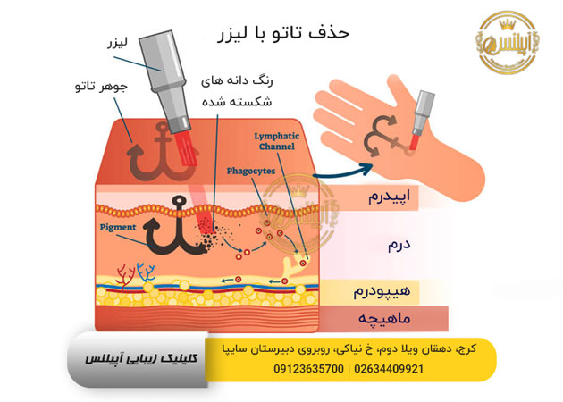چگونگی حذف تاتو با لیزر 