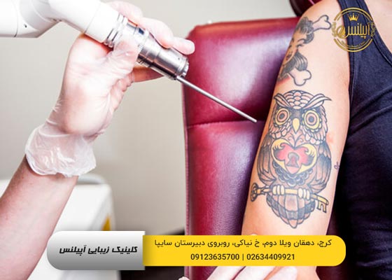 حذف تاتو کرج