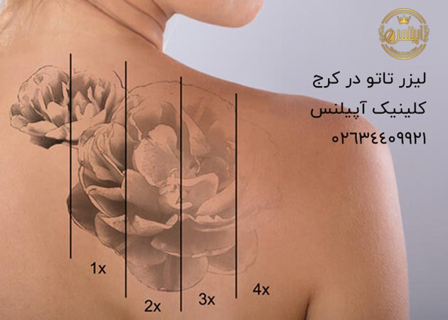 مراحل پاک کردن تاتو در کرج