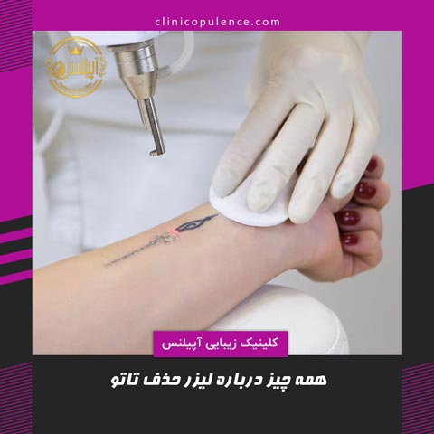 لیزر حذف تاتو کرج