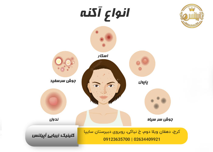 انواع آکنه و روش درمان 