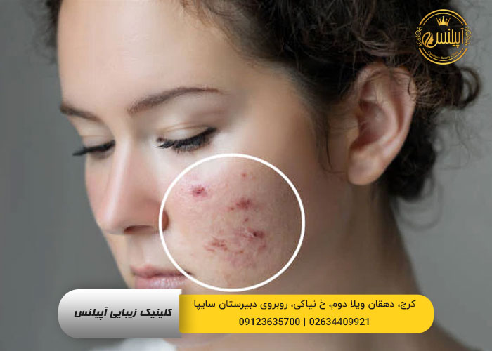 درمان لک صورت به صورت خانگی درمان جوش و آکنه 