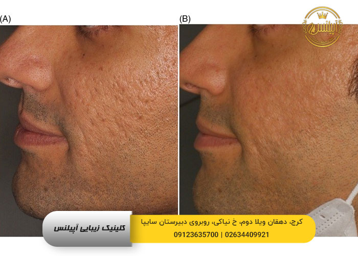 سابسیژن جای جوش و اسکار 