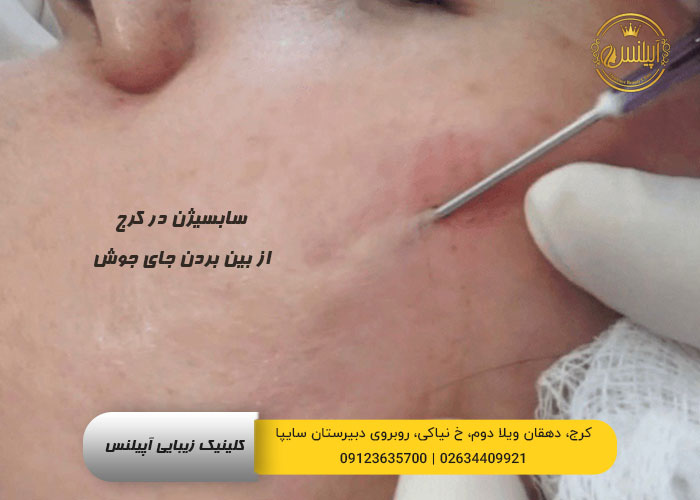 سابسیژن در کرج 