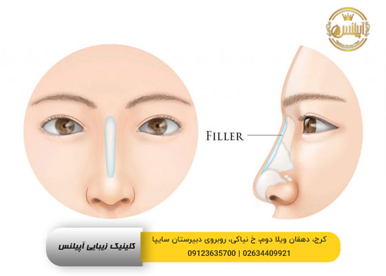 تزریق فیلر بینی کرج