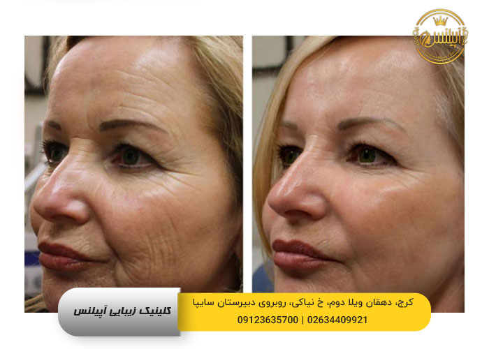 هایفوتراپی صورت کرج