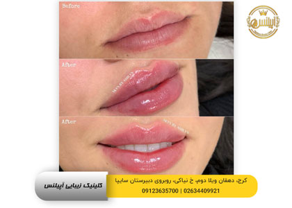 تزریق فیلر لب برای جوانسازی در کرج