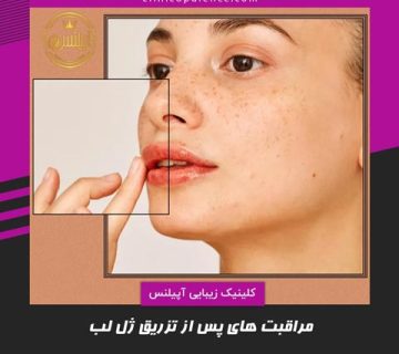 مراقبت پس از تزریق ژل لب