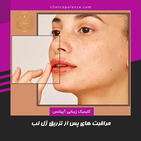 مراقبت پس از تزریق ژل لب