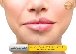 تزریق ژل لب کرج