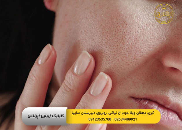 مراقبت پوست خشک