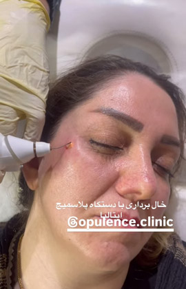 خال برداری در کرج