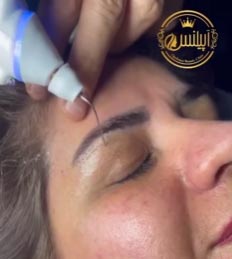 رفع افتادگی پلک
