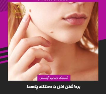 برداشتن خال با دستگاه در کرج