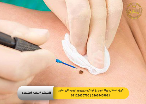 برداشتن خال در کرج با دستگاه پلاسما جت