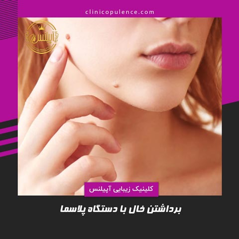 برداشتن خال با دستگاه در کرج