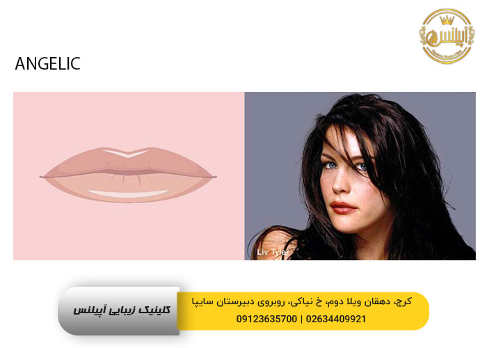 مدل جدید ژل لب تزریق در کرج طرح آنجلیک