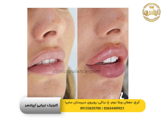 تزریق فیلر لب روسی در کرج