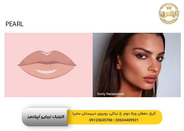 طرح ژل لب مرواریدی فیلر مروارید در کرج