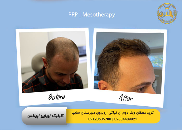 پی ار پی در کرج prp
