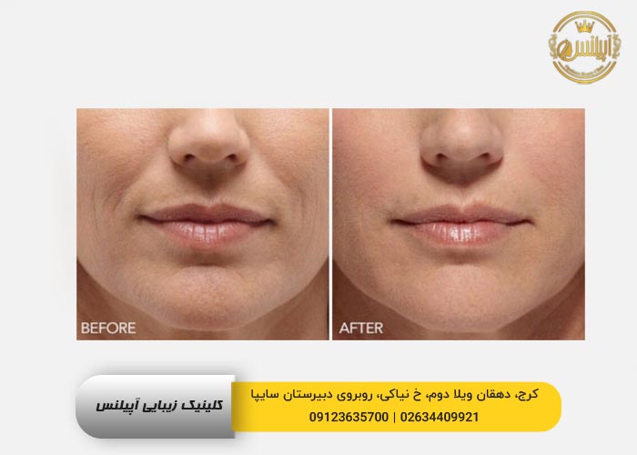 رفع خط خنده با ژل 