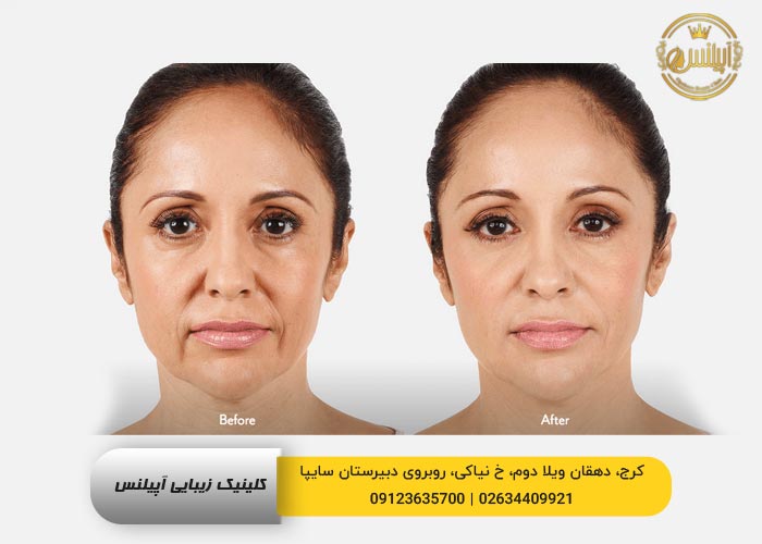 رفع خط خنده در کرج با ژل و فیلر 