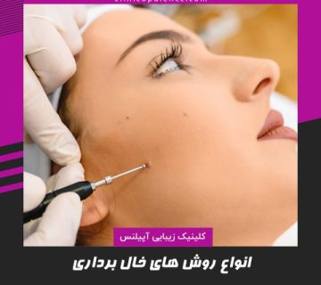 برداشتن خال در کرج