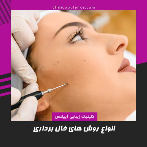 برداشتن خال در کرج
