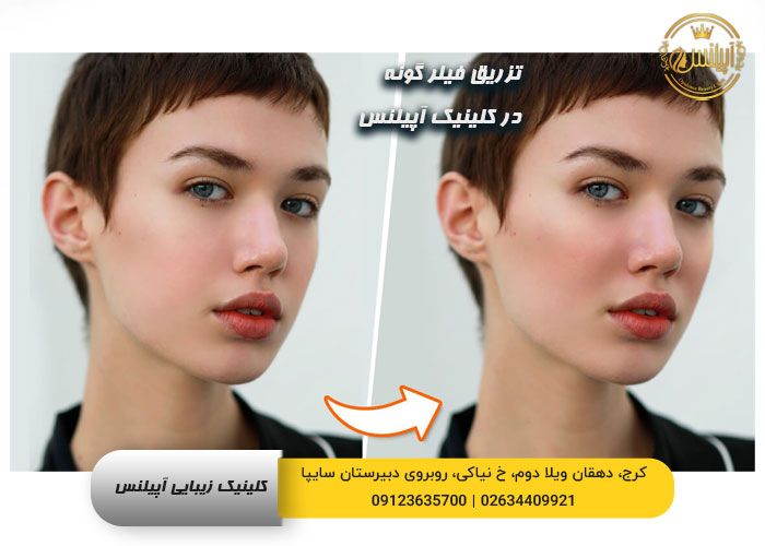 فیلر گونه در کرج