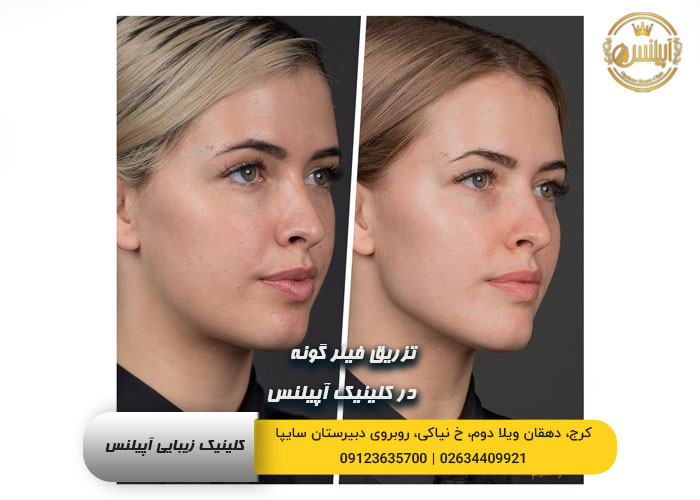 تزریق ژل گونه در کرج