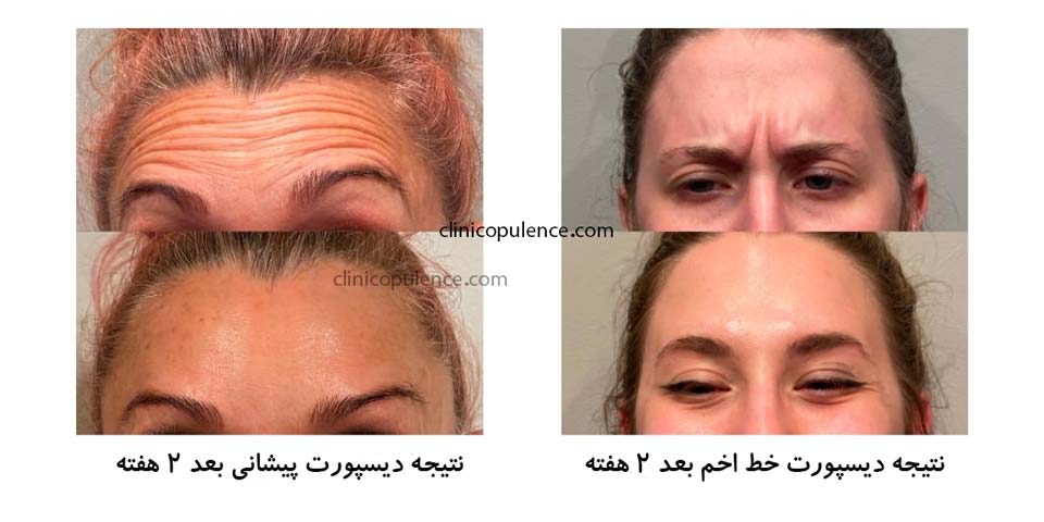 دیسپورت تزریق کرج