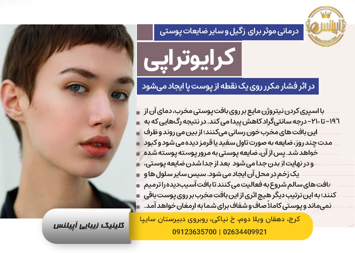 کرایوتراپی زگیل انجماد سرمادرمانی کرج