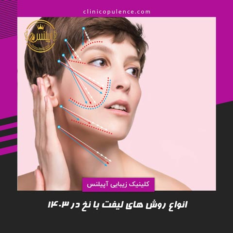 روش های لیفت با نخ در کرج کاگ مونو اسکرو