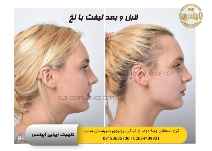قبل و بعد لیفت با نخ صورت و چانه در کرج