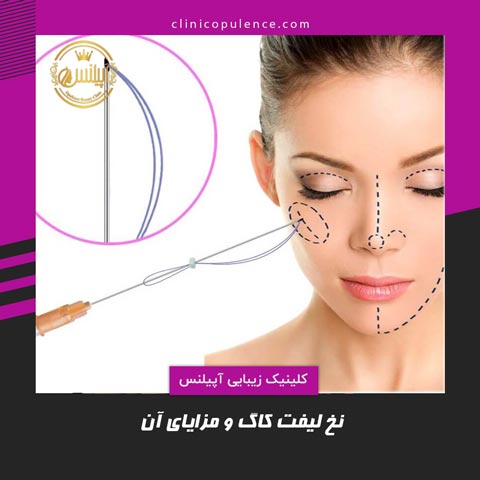 نخ لیفت کاگ