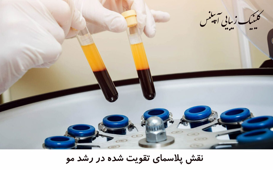 پی آر پی تقویتی مو پلاسما
