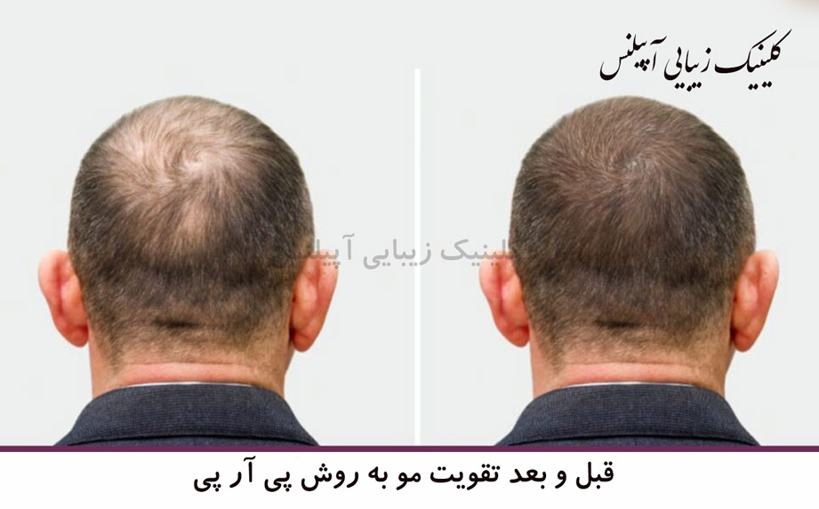 قبل و بعد پی آر پی 