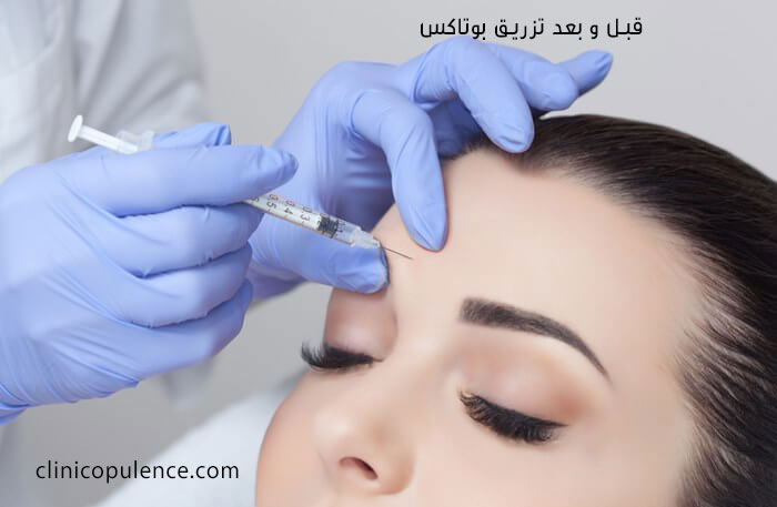 قبل و بعد تزریق بوتاکس 