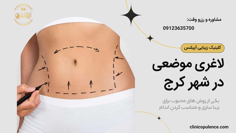 لاغری موضعی کرج