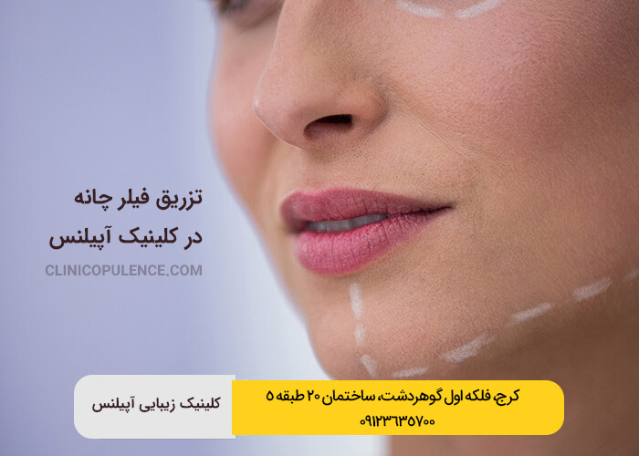 فیلر چانه ژل چانه کرج تهران