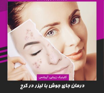 لیزر جای جوش کرج تهران