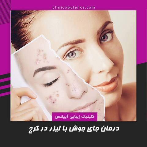 لیزر جای جوش کرج تهران