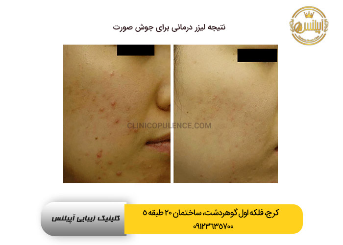 لیزر جای جوش نمونه کار کرج