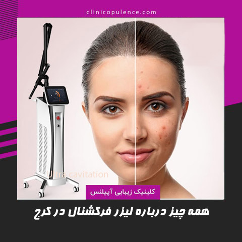 لیزر co2 فرکشنال