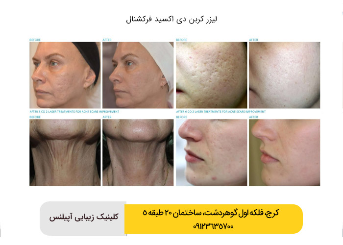 لیزر فرکشنال co2